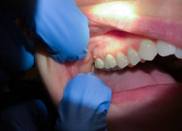 Best Knocked-Out Tooth Emergency  in Somerdale, NJ